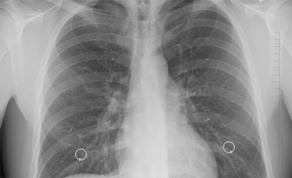Pražští plicní lékaři odhalili v kraji 14 nemocných 