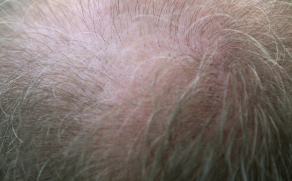 Pacientům s alopecií pomáhají malé molekuly